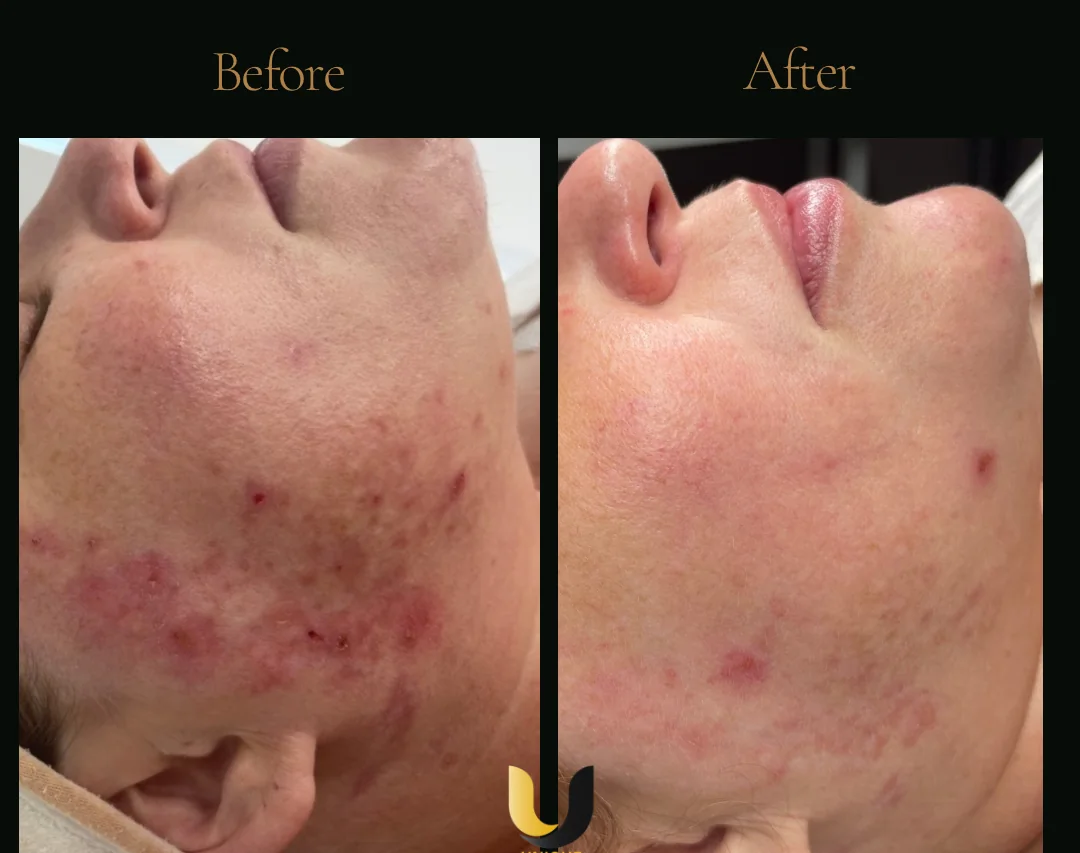 Before and after BioRePeel and microneedling skin result