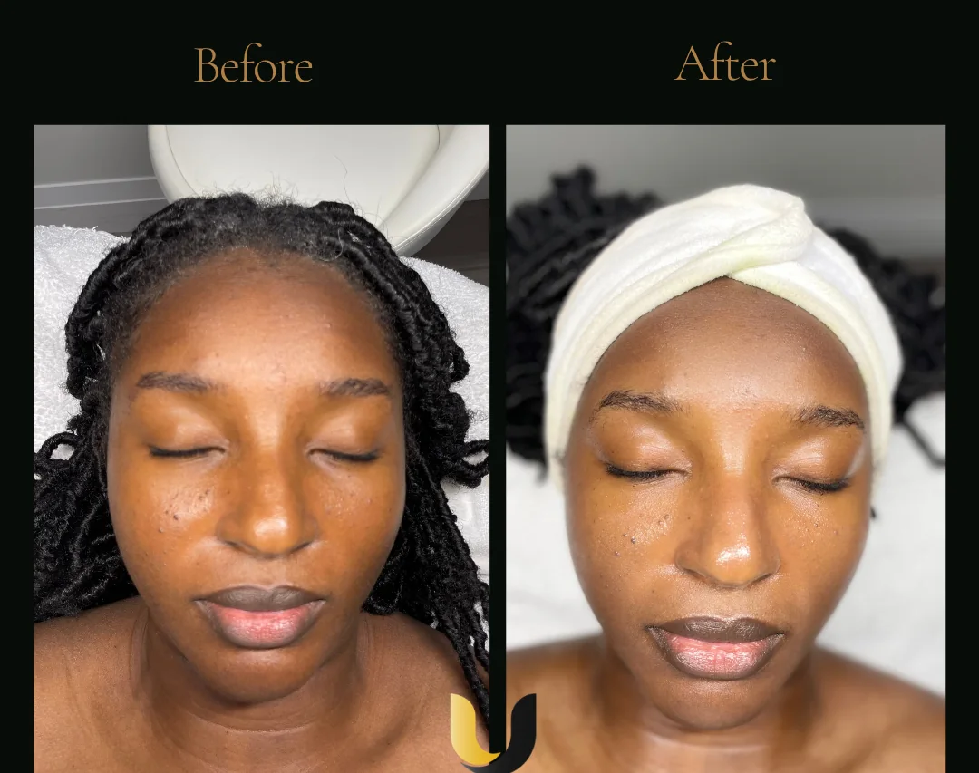 Before and after BioRePeel and microneedling result after two sessions