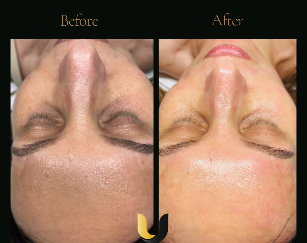 Before and after BioRePeel facial result after one session