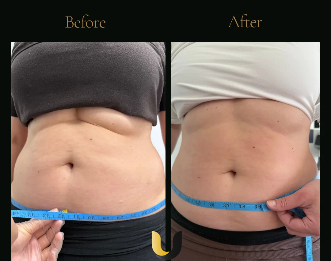 Before and after body sculpting abdomen result after four sessions