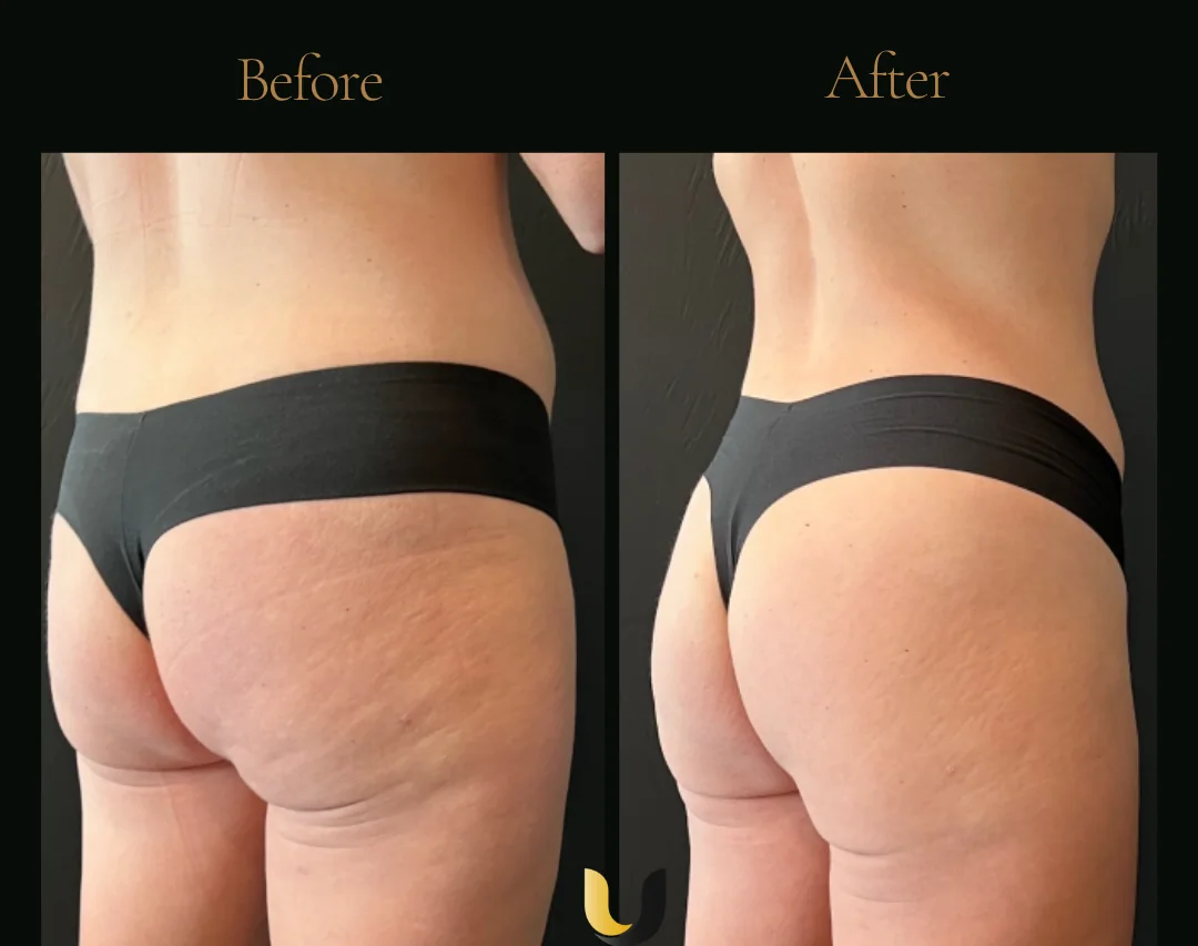 Before and after body sculpting result after six sessions