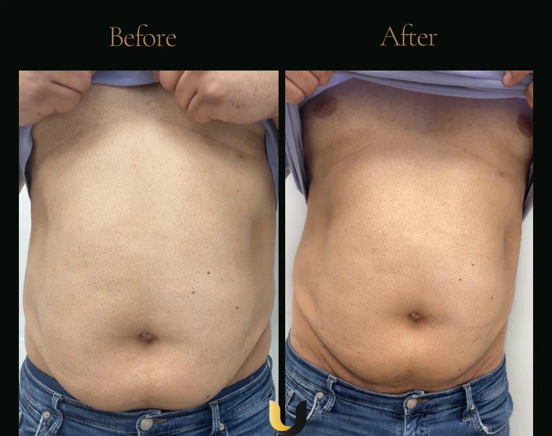 Before and after body sculpting result after six sessions