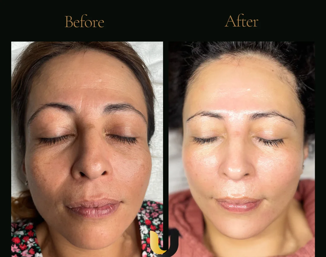 Before and after customised skin treatment result after five sessions
