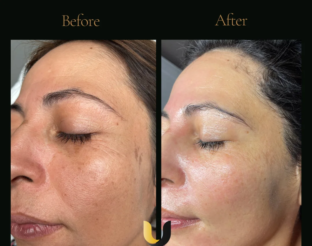 Before and after customised skin treatment plan result