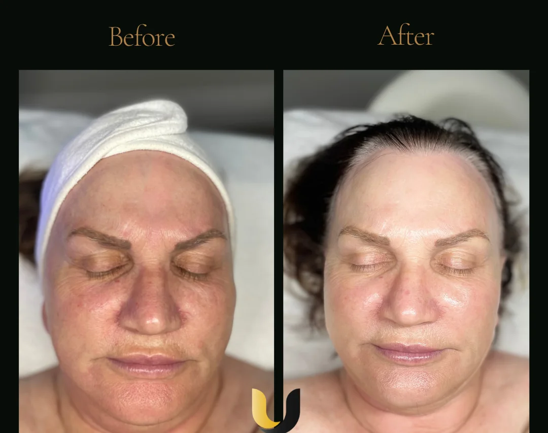 Before and after HydraFacial and customised peel result
