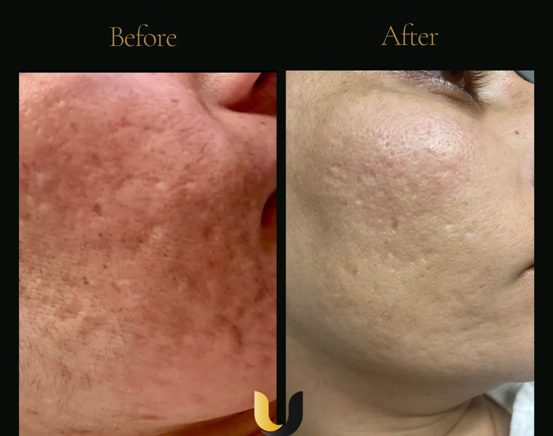 Before and after customised melasma treatment result