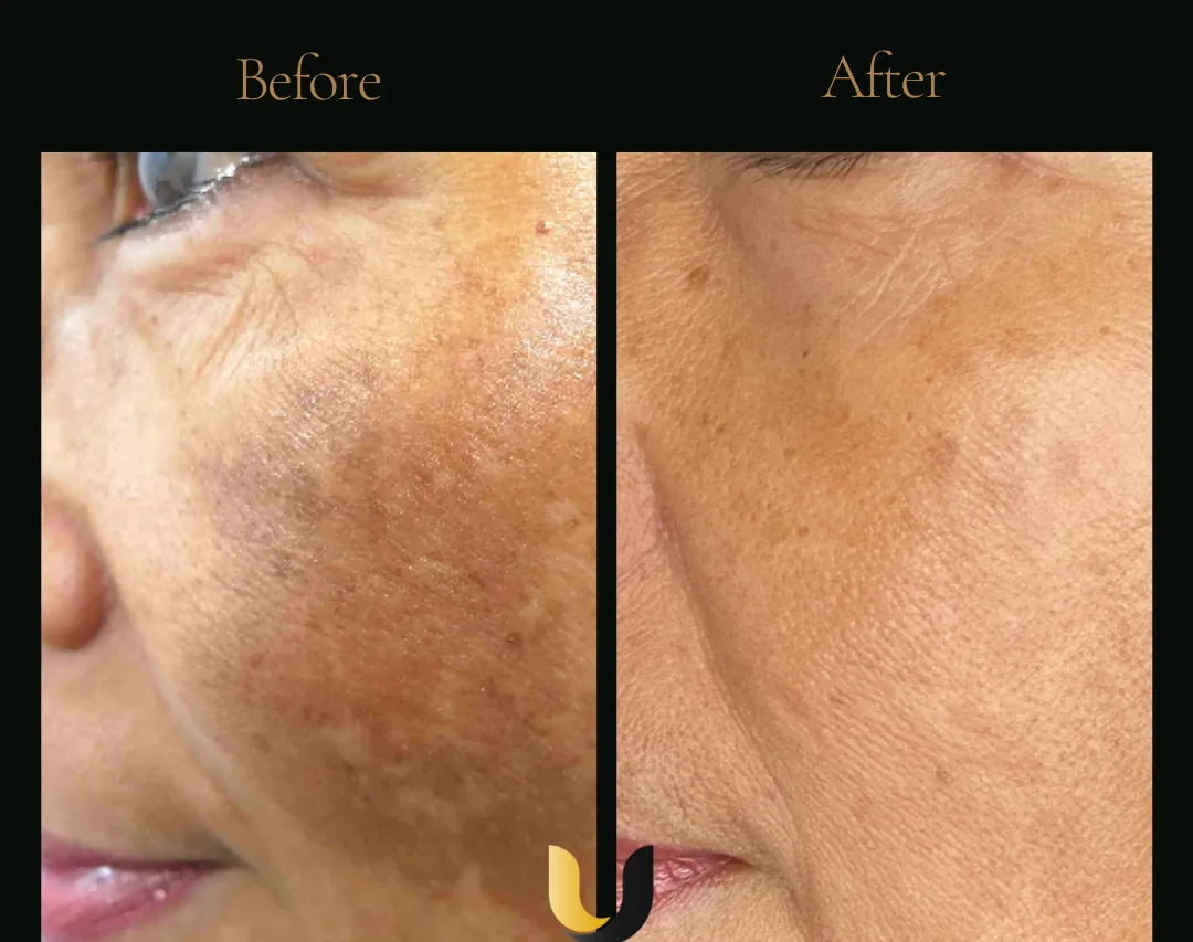 Before and after melasma treatment result showing tone improvement