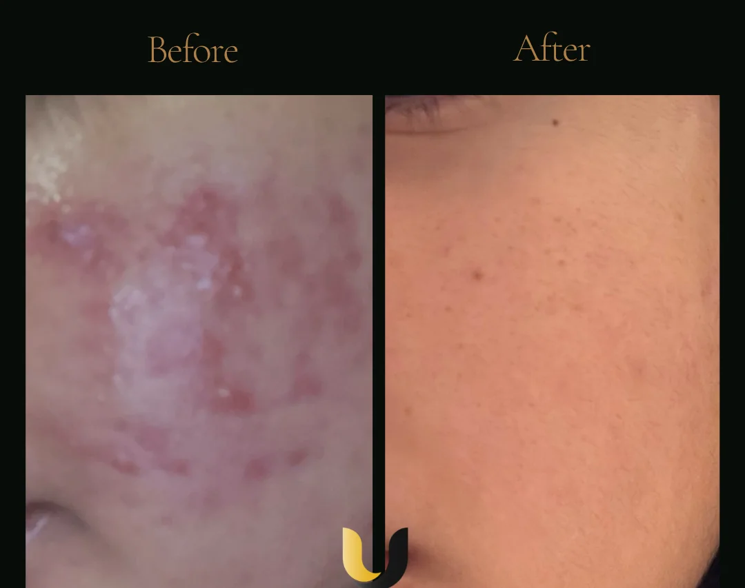Before and after microneedling result with stem cells