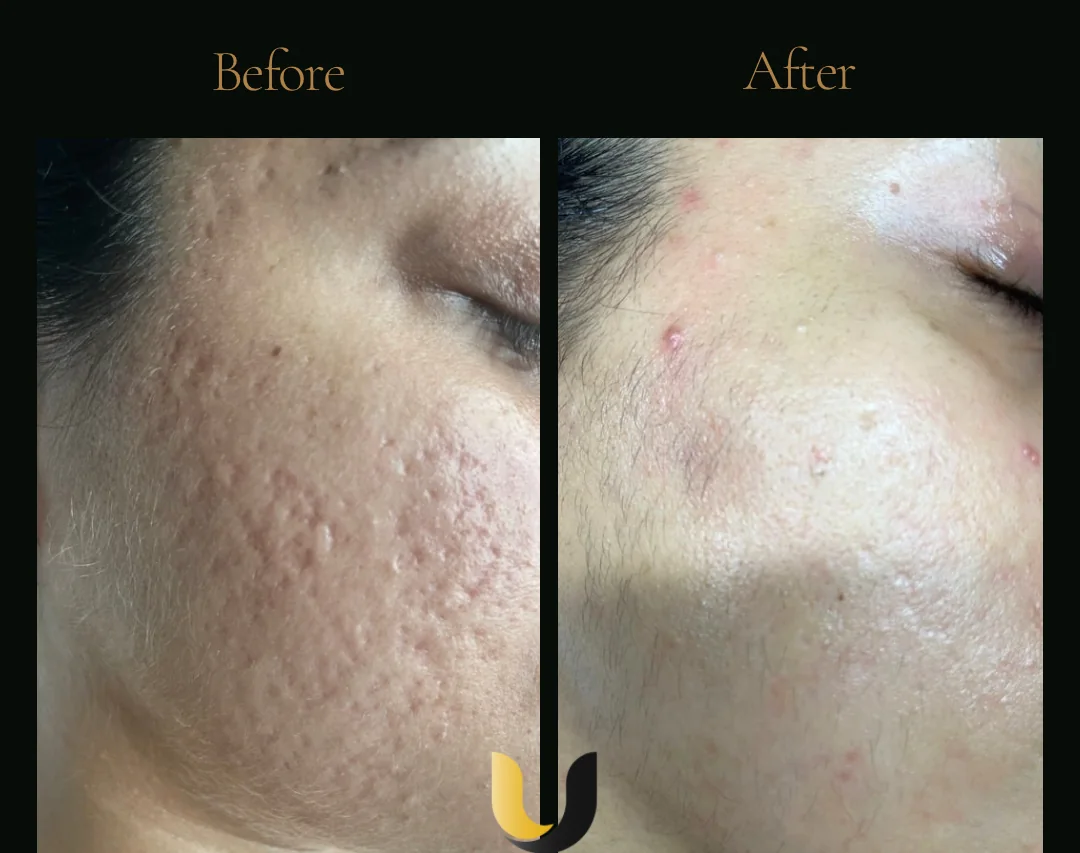 Before and after RF microneedling texture result after three sessions