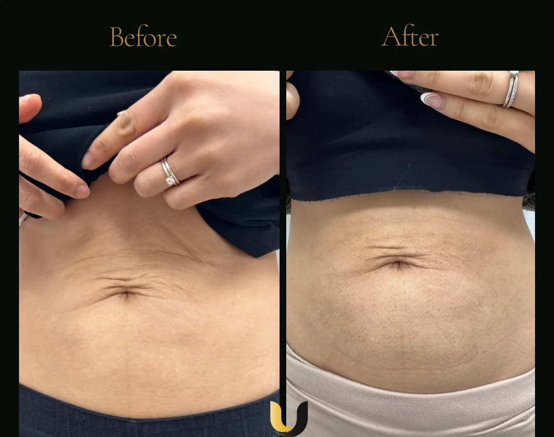 Before and after abdominal RF microneedling result after three sessions