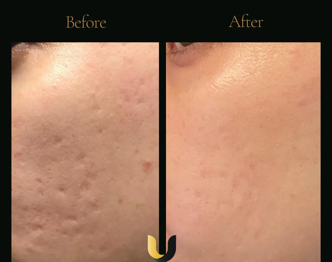 Before and after RF microneedling result with exosomes and Salmon DNA