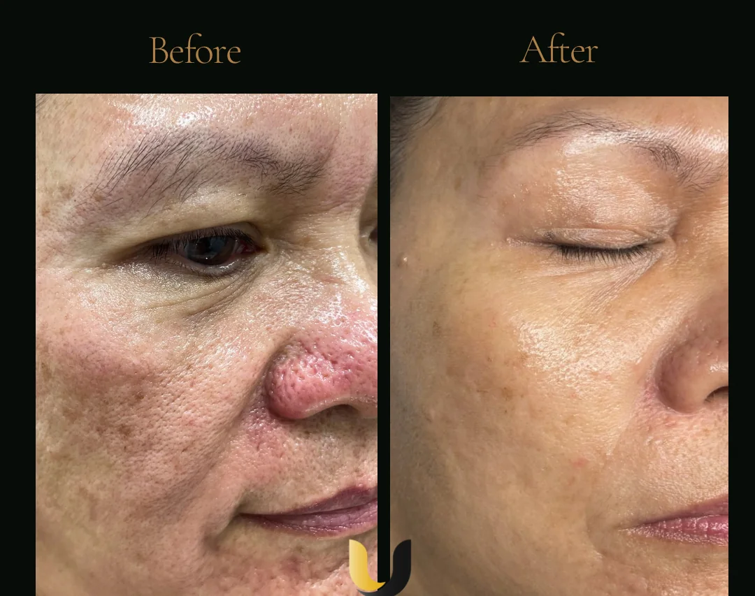 Before and after RF microneedling result with Salmon DNA
