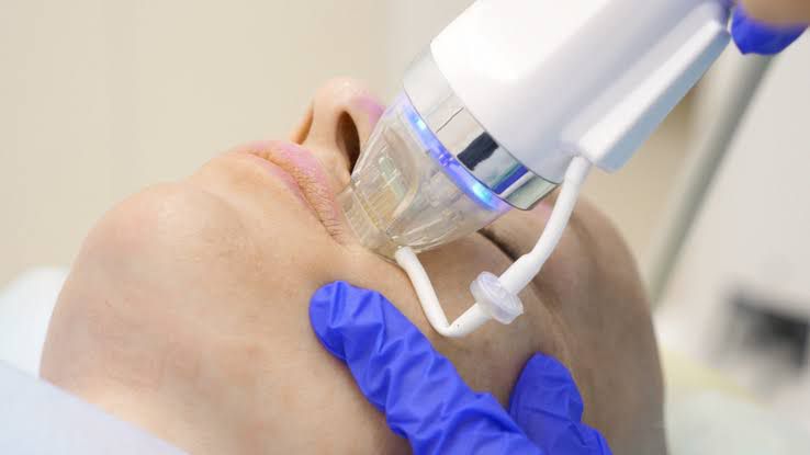 RF microneedling treatment being performed at Unique Aesthetics in Brantford